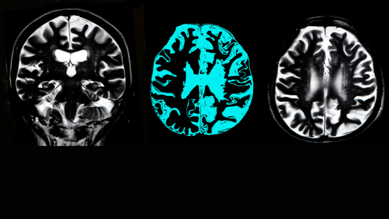 MRI images from brain scans of patients suffering from Alzheimer’s Disease