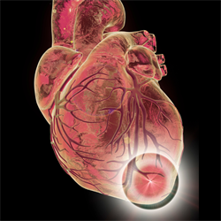 illustration of myocardial infarction